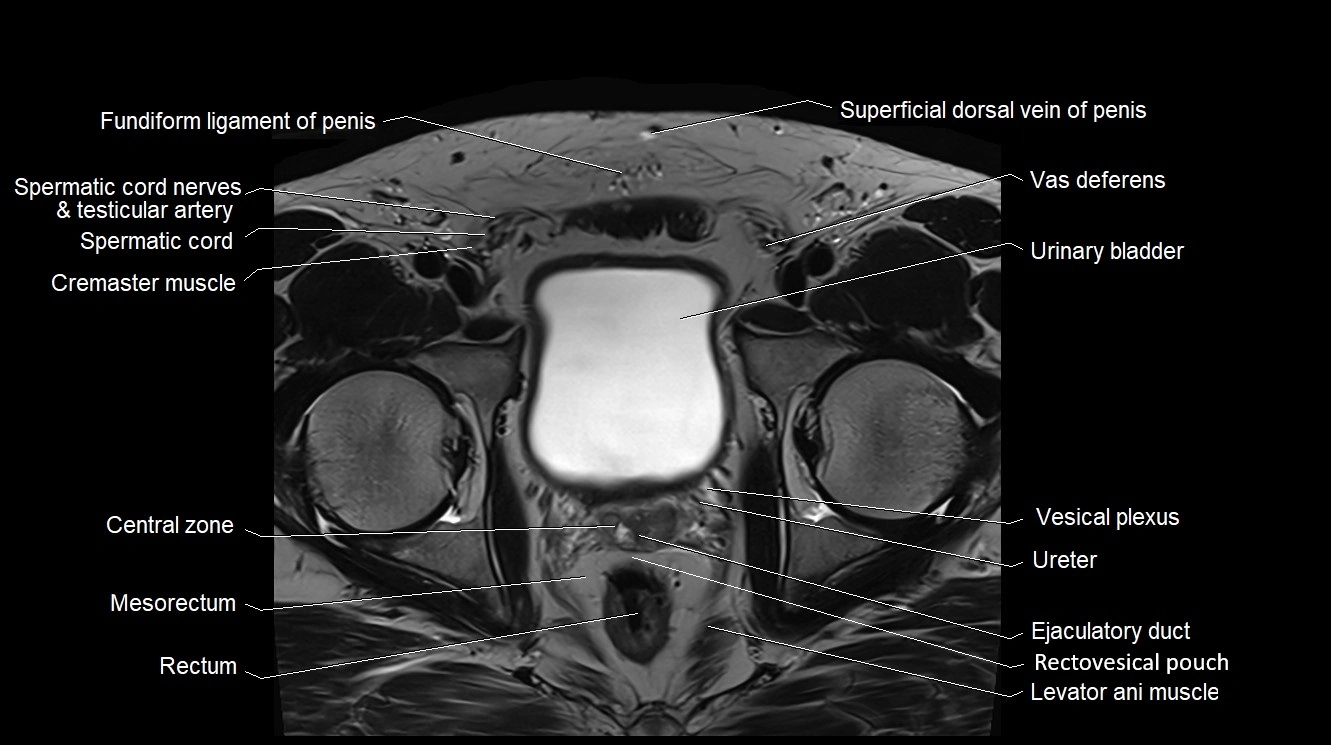 MRI 3T scrotum and penis axial cross sectional anatomy image 4.webp